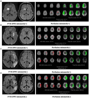 Comparison between MRI FLAIR vascular hyperintensity-DWI mismatch and perfusion based triage for thrombectomy in the late time window